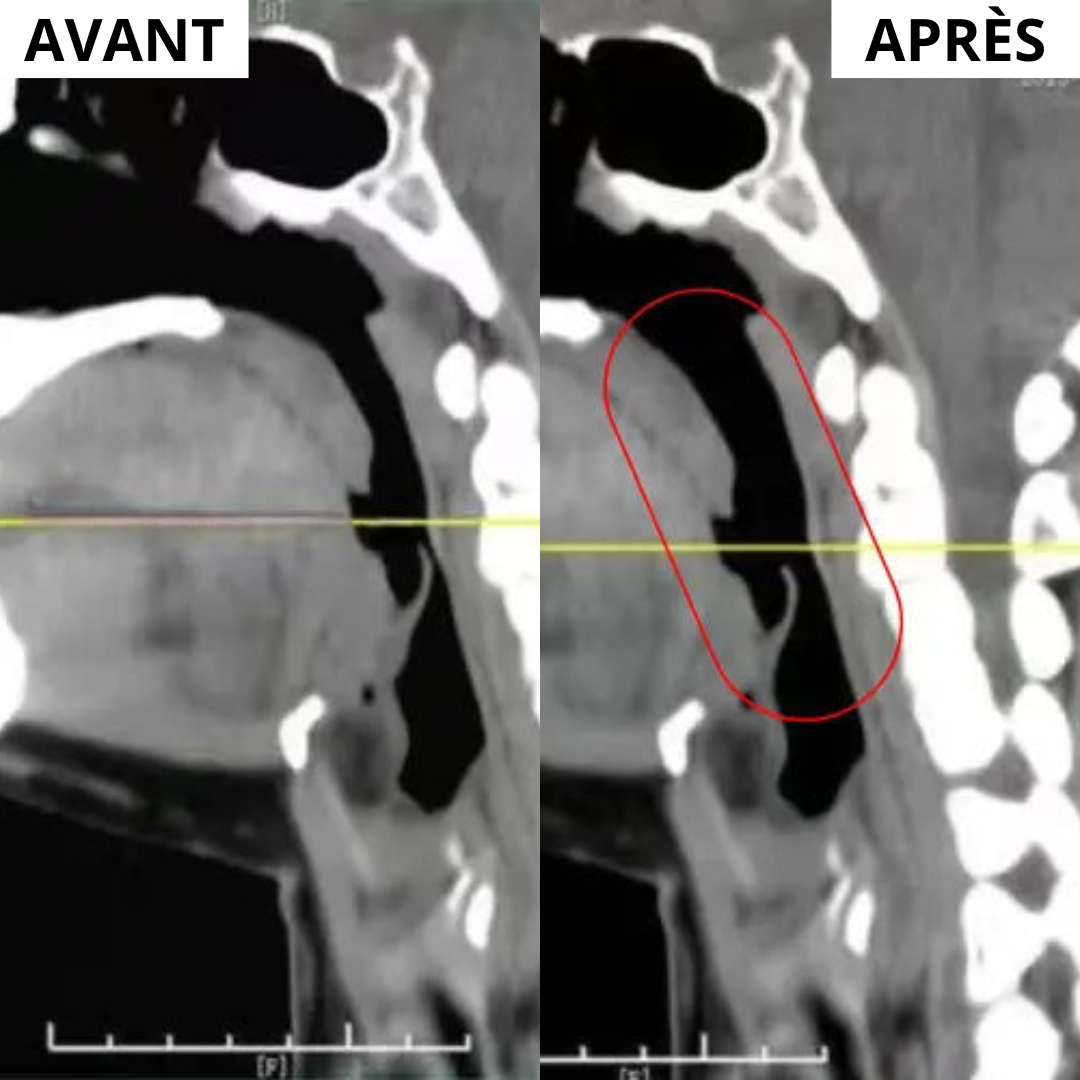 Dispositif anti-ronflement